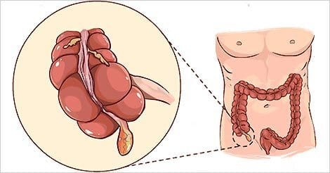 Appendicitis: Understanding the Condition