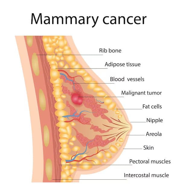 Breast Cancer: Understanding the Condition