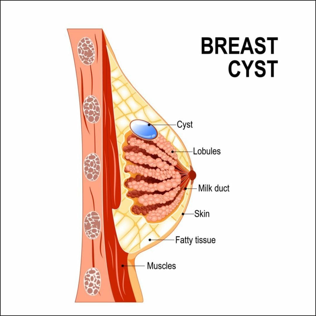 Breast Cyst: Understanding the Condition