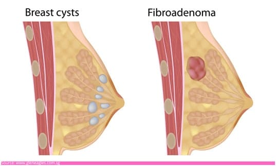 Breast Lump: Understanding the Condition