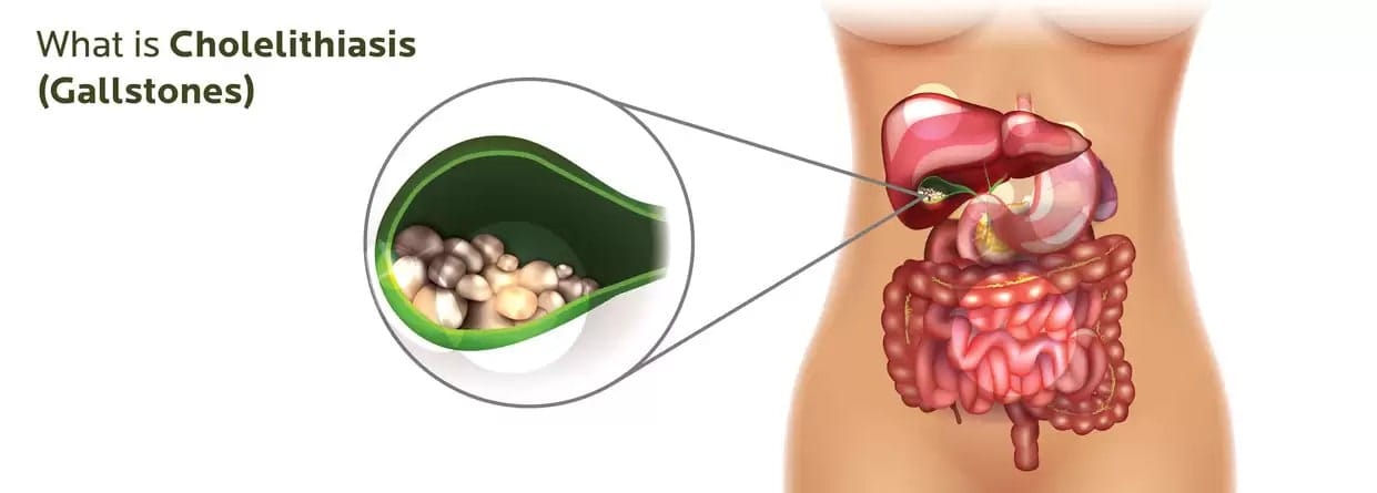 Cholelithiasis: Understanding the Condition