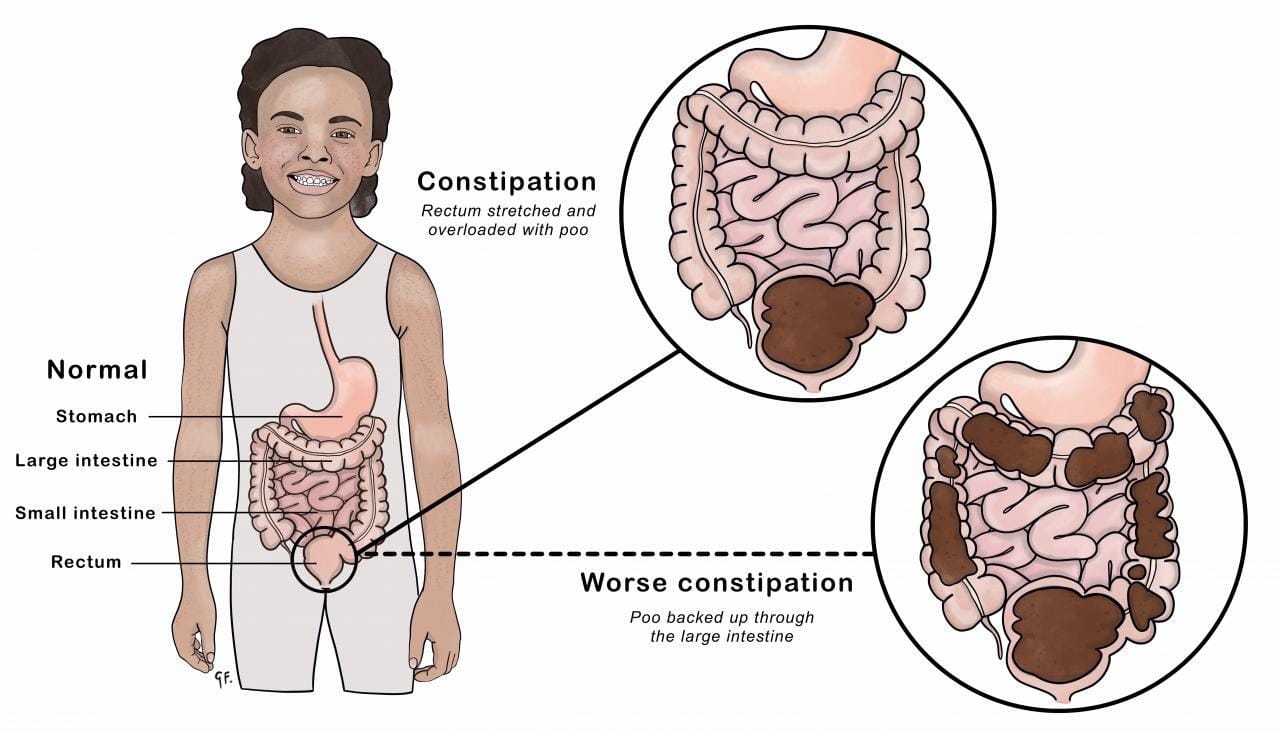 General health tips for constipation