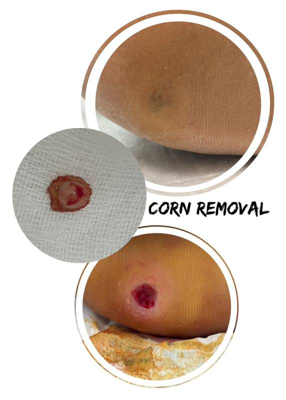 Patient Story: Corn Foot Removal