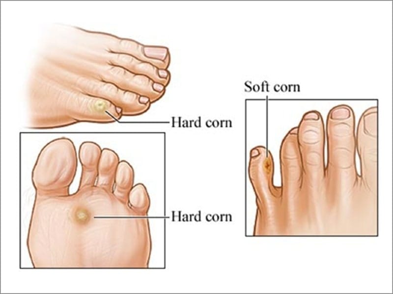 Preventive measures for corn foot