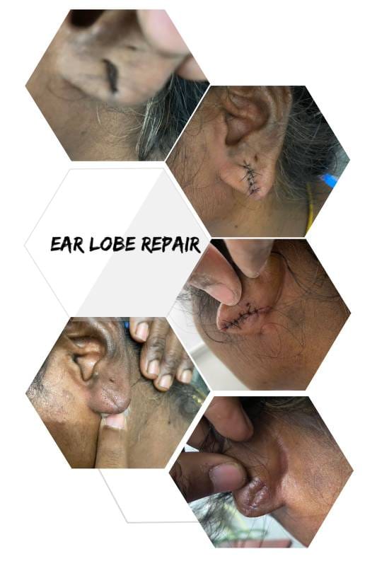 Patient Story – Ear Lobe Repair at Sharmi Clinic