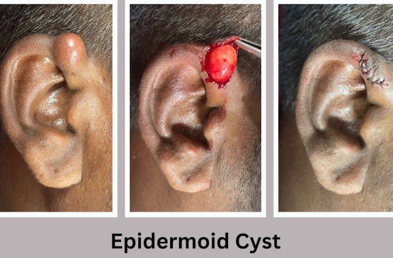 Patient Story: Epidermoid Cyst Removal