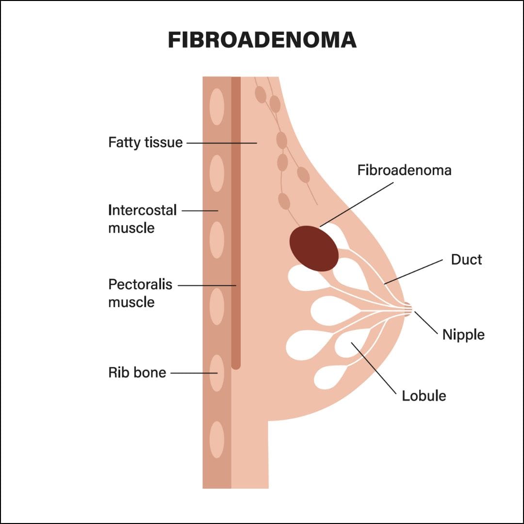 Fibroadenoma: Understanding the Condition