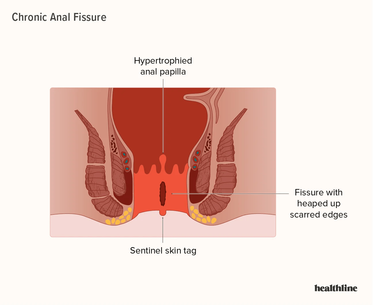 Fissure in Ano: Understanding the Condition