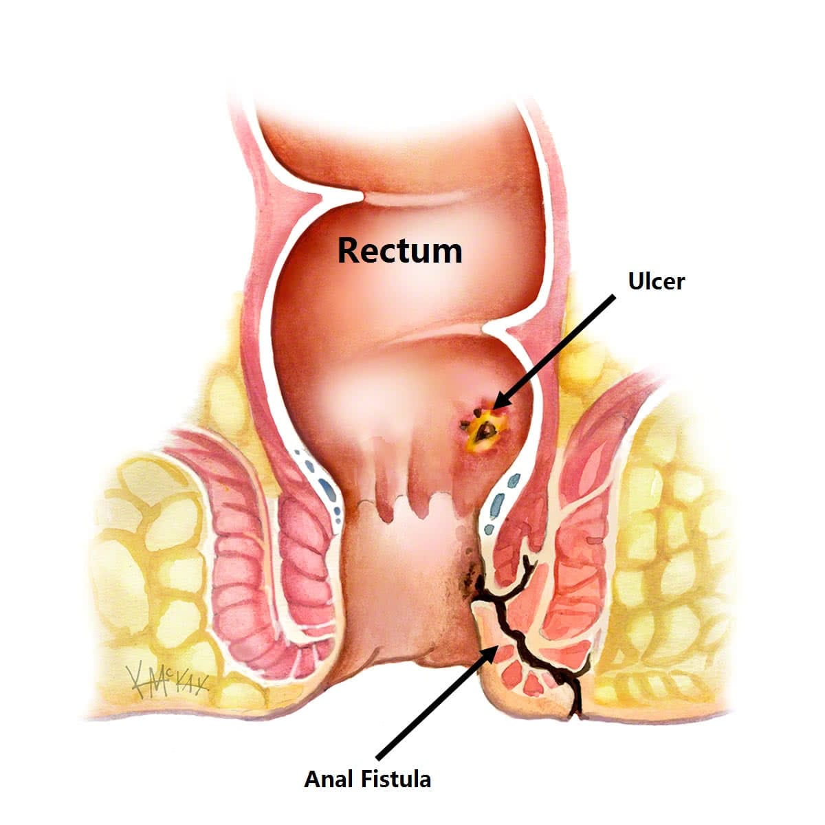 Fistula in Ano: Understanding the Condition