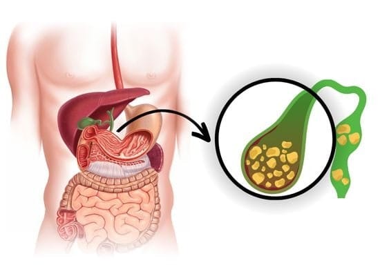 Gallbladder Stones: Understanding the Condition