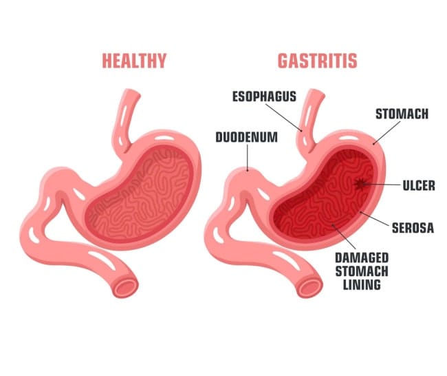 Gastritis: Understanding the Inflammation of the Stomach Lining