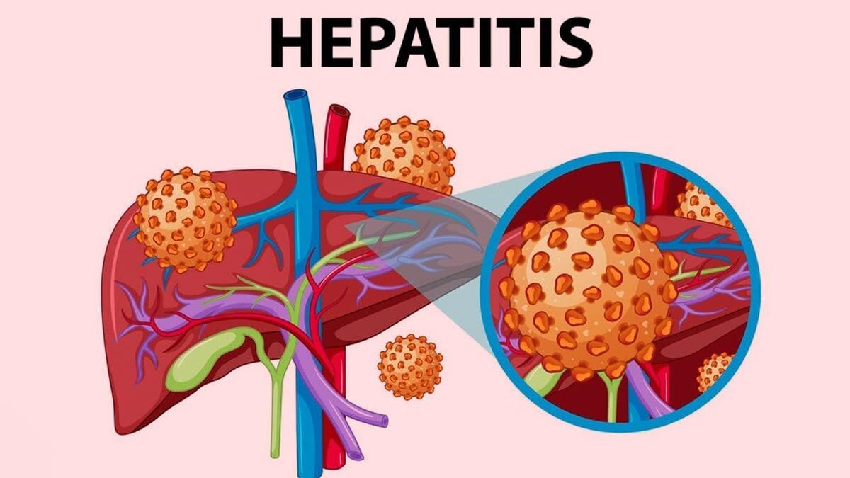 Hepatitis: Understanding the Condition