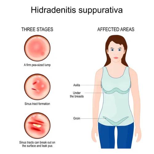 Hidradenitis Suppurativa: Understanding the Condition