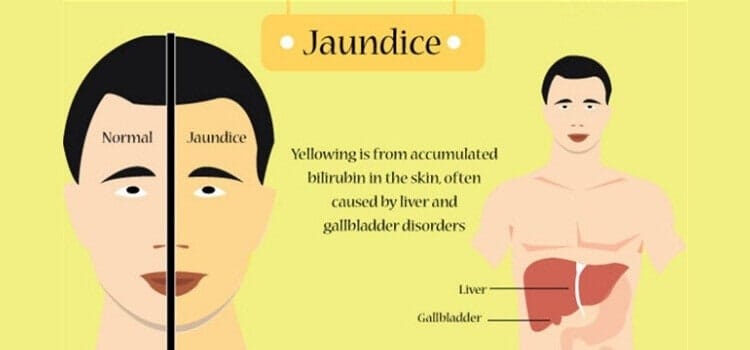 Jaundice: Understanding the Condition