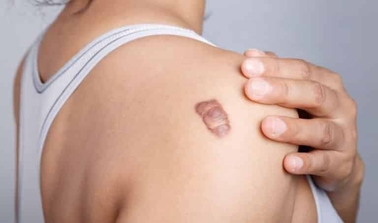 Keloid: Understanding the Condition