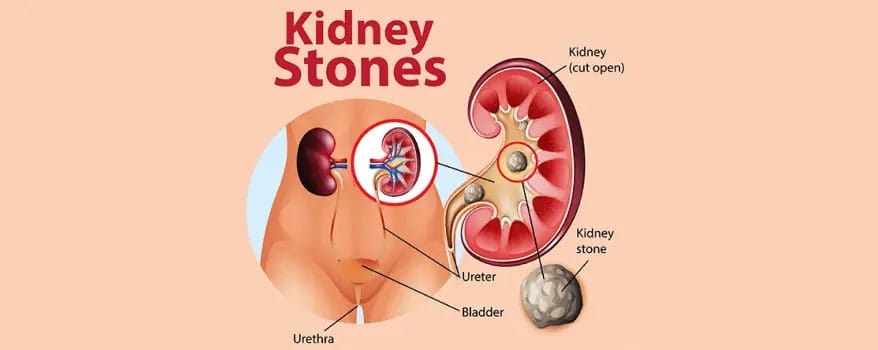 Kidney Stones: Understanding the Condition