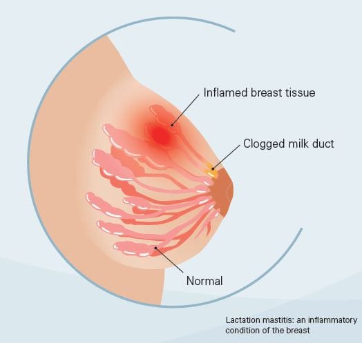 Mastitis: Understanding the Condition