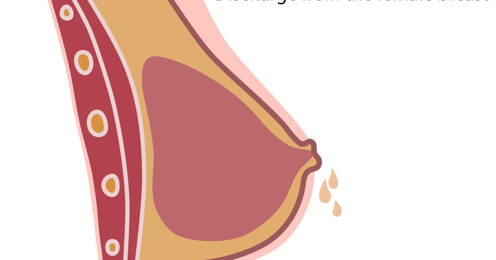 Nipple discharge: An Overview