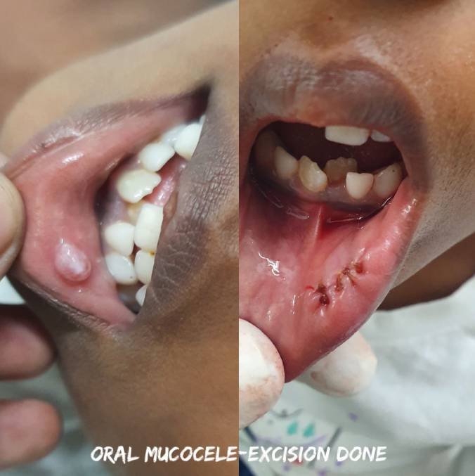 Patient Story: Oral Mucocele Cyst Removal