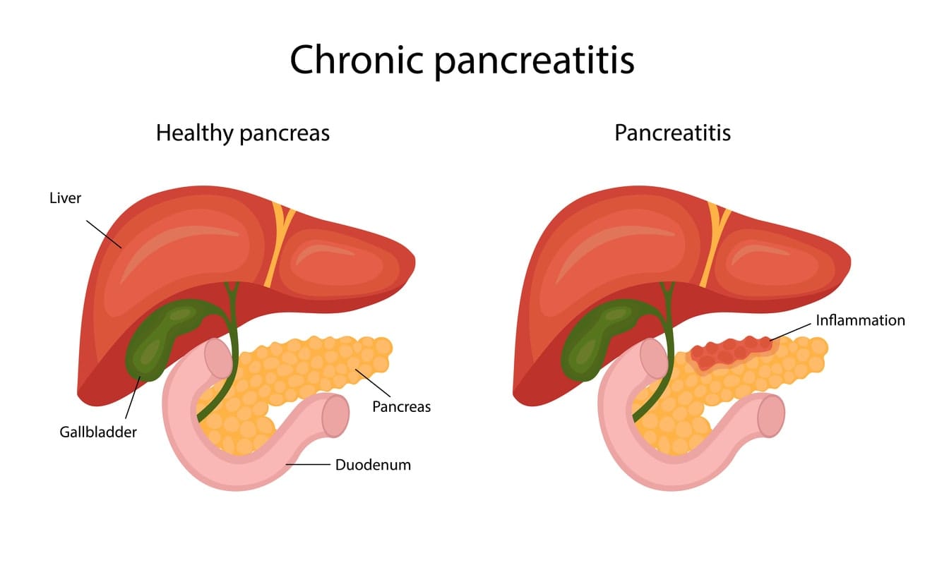 Pancreatitis: Understanding the Condition