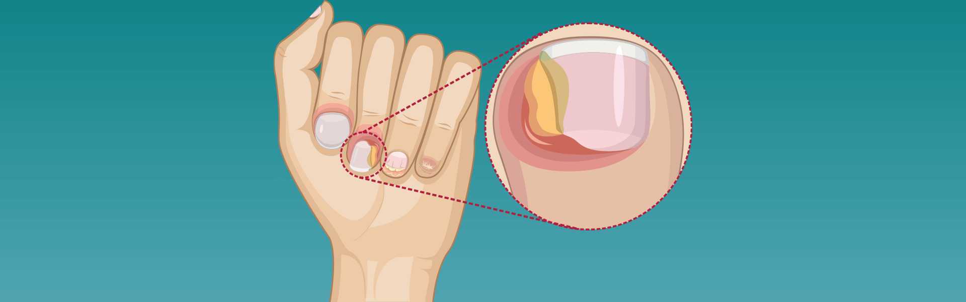 Paronychia: Understanding the Condition