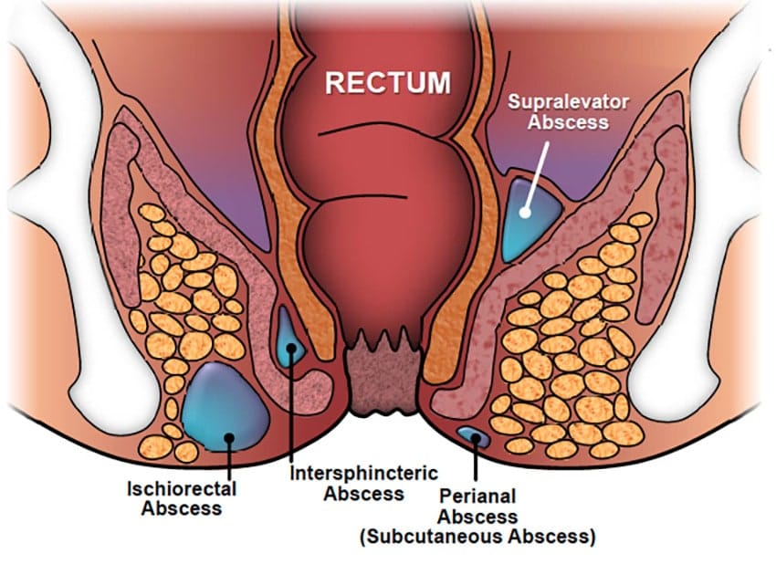 Perianal Abscess: Understanding the Condition