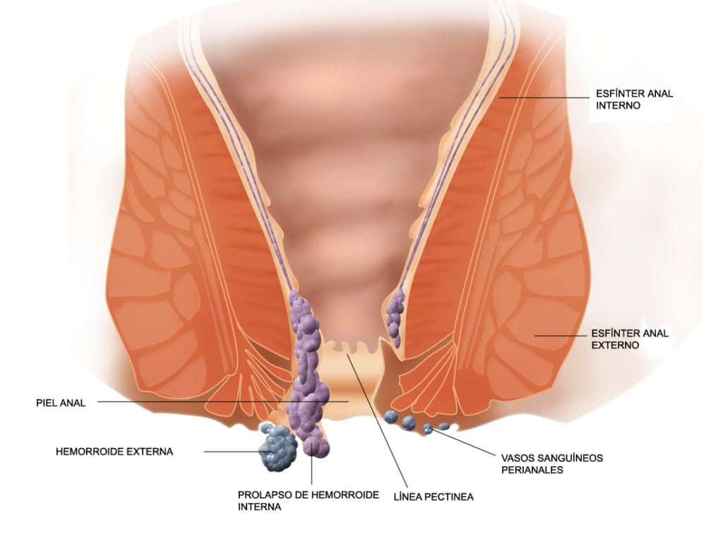 Piles (Hemorrhoids): Understanding the Condition