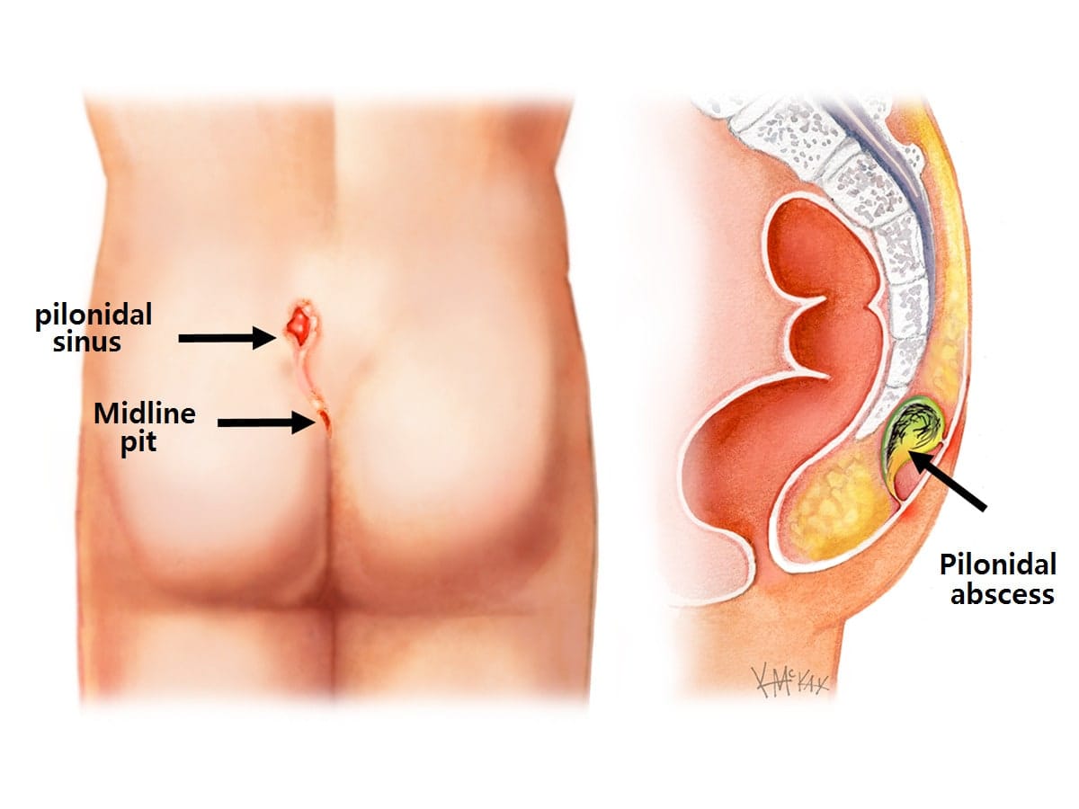 Pilonidal Sinus: Understanding the Condition