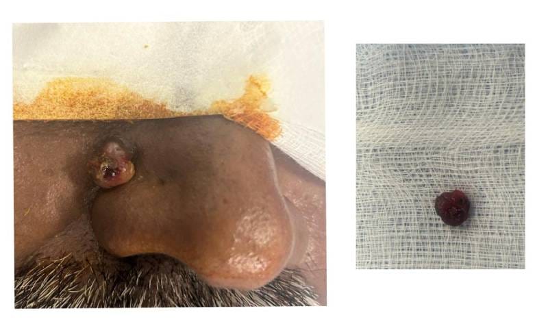 Patient Story – Pyogenic Granuloma Removal at Sharmi Clinic