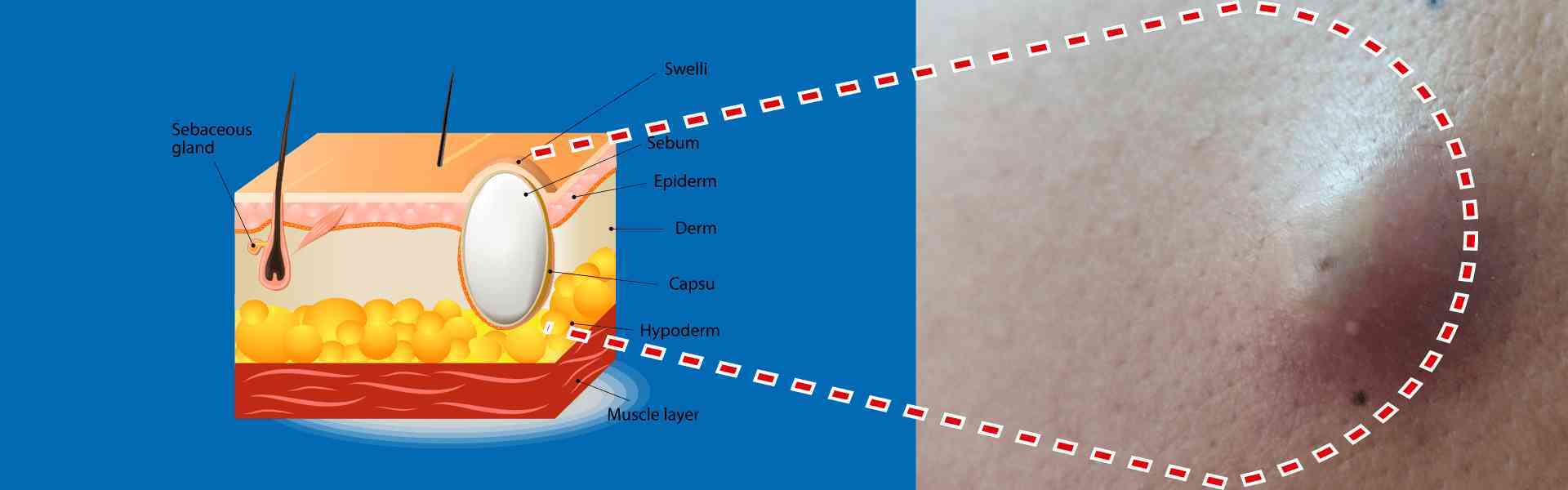 Sebaceous cyst: Understanding the Condition