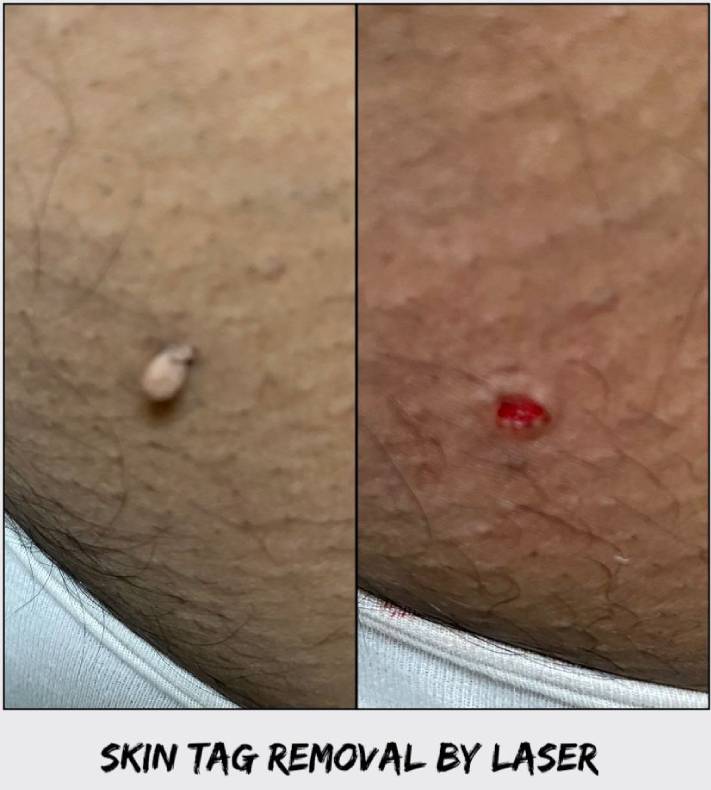 Patient Story: Skin Tag Removal