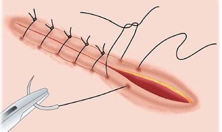 Suturing: Understanding the Procedure