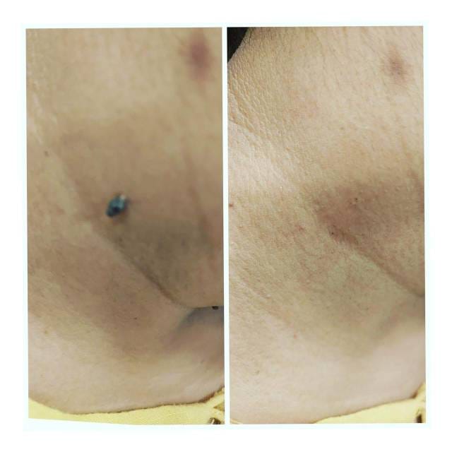 Patient Story – Wart Removal at Sharmi Clinic