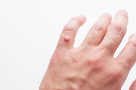 Wart: Understanding the Condition